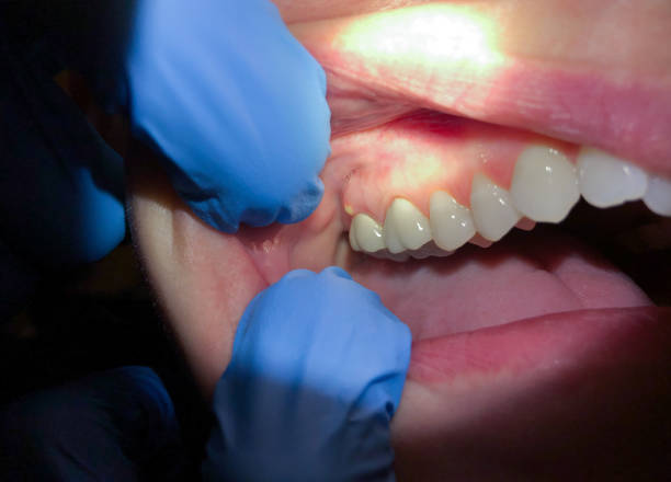 Best Emergency Wisdom Tooth Extraction in Mammoth Spring, AR