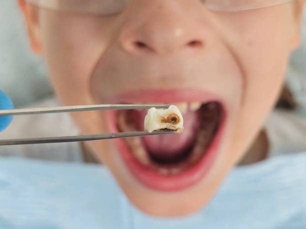 Best Emergency Treatment for Oral Infections in Mammoth Spring, AR